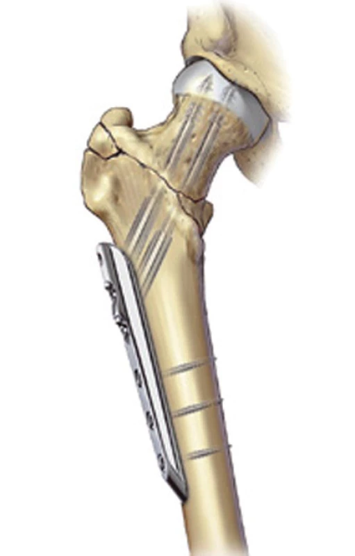 Schéma narušení laterální kortiky DHS ( průměr 16-32mm) k PC.C.P. (průměr 9,3mm)