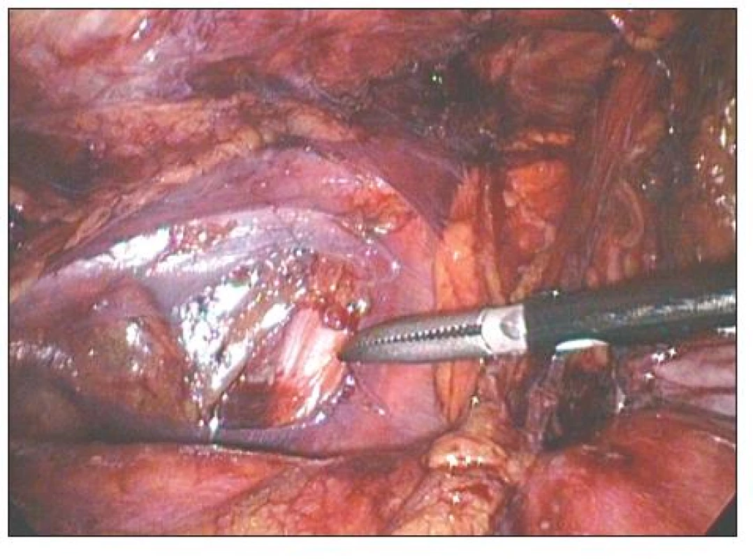 TAPPlevého třísla. Špička disektoru ukazuje na r. femoralis n. genitofemoralis
Fig. 2. TAPPof the left groin. The dissector tip points at r. femoralis n. genitofemoralis