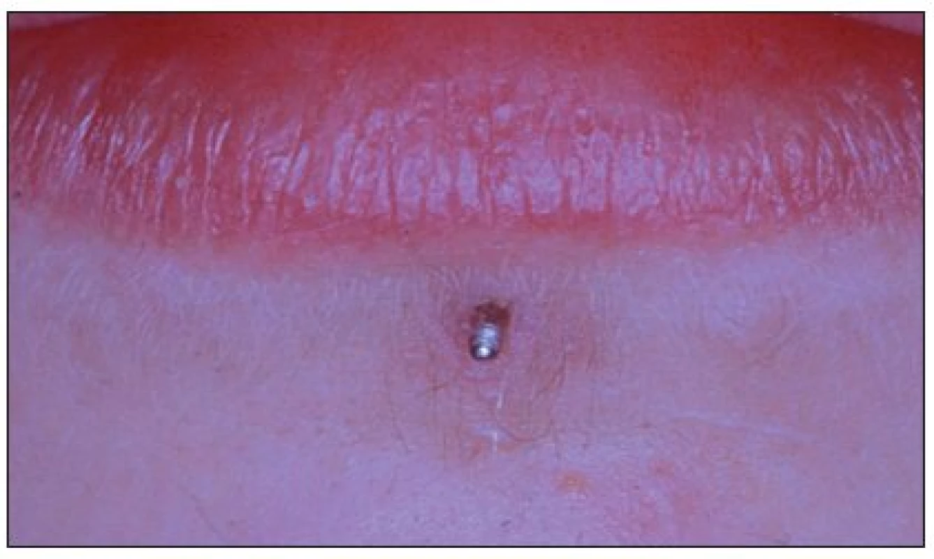 Piercing dolního rtu.