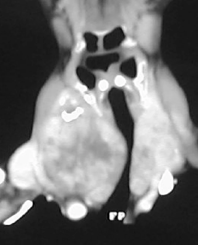 Stenoza průdušnice – CT sken
Fig. 2: Stenosis of the trachea – CT scan
