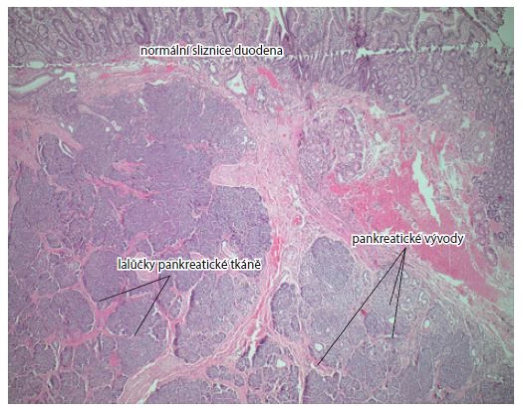 Normální duodenální sliznice, acini, pankreatické vývody.
Barvení hematoxylin-eozinem, zvětšení 5×.<br>
Fig. 4. Normal duodenal mucosa, acini, pancreatic ducts. Haematoxylin and eosin
staining, magnification 5×.