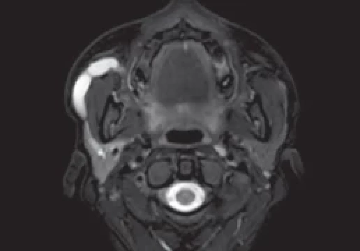 MRI showing liquid collection in the right Stensen’s duct, with three stenotic lesions.