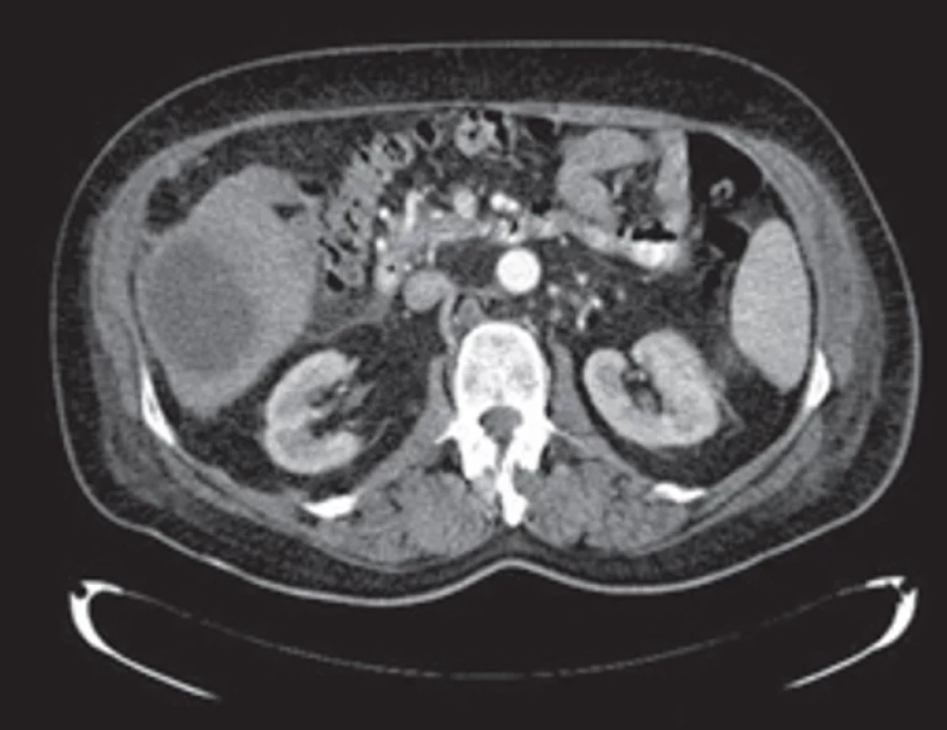 Axiální CT scan – největší metastatické ložisko v pravém jaterním laloku (segmenty V–VI). Fig. 4. Axial CT scan – the largest metastatic lesion in the right hepatic lobe (segments V–VI).