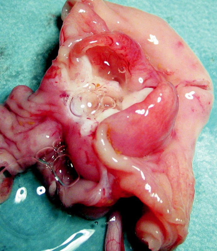 Discidovaná hrubostenná črevná duplikatúra s mucinóznym obsahom
Fig. 7. Dissected thick- walled duplicature with a mucous content