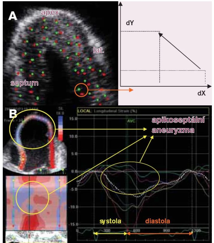 Základní principy speckle tracking echokardiografie a její hodnocení.
A. Ultrazvukové vlnění vytváří interferenci při průchodu tkání myokardu v důsledku odrazu, lomu a pohlcení specifické ultrazvukové obrazce podobné skvrně – speckle. Tyto speckle jsou pomocí speciálního software rozpoznávány z dvourozměrného zobrazení – B-mode a jsou detekovány během celého srdečního cyklu v jednom R-R intervalu při současně registrovaném EKG. Poloha speckle se tak mění během srdečního cyklu v čase od časné systoly (červený bod) k pozdní diastole (zelený bod), přičemž off-line je vypočítávána změna polohy daného speckle-displacement (mm), dále rychlost změny této pozice (cm/s), míra deformace daného segmentu- strain (%) a rychlost této deformace- strain rate (s-1) pro danou vyšetřovanou oblast zájmu, která ve většině případů odpovídá segmentu. Uvedené parametry jsou vypočítávány pro dvě na sebe kolmé roviny v daném zobrazení. Pro projekce na dlouhou osu LK jsou měřeny longitudinální a transverzální charakteristiky, pro projekce na krátkou osu LK radiální a cirkumferenciální charakteristiky. Navíc ze 3 projekcí v krátké ose v jednotlivých úrovních LK (baze, papilární svaly a apex) lze vypočítat regionální a globální rotaci respektive torzi LK- viz výše (volně podle Marwicka [4]).
B. Off-line analýza je prováděna ve speciálním softwarovém prostředí. V levé horní části je v superponovaném dvourozměrném zobrazení z apikální 4dutinové projekce patrná hodnota vrcholového longitudinálního systolického strain - ε (%) v barevné škále. Již z tvaru LK je patrné, že se jedná o pacienta po proběhlém transmurálním infarktu přední stěny (ověřené magnetickou rezonancí) s remodelací LK do apikoseptálního aneuryzmatu. Ve třech segmentech LK uvedené projekce (midseptální označený světle modře, apikoseptální - zeleně, apikolaterální - fialově) je patrná podle barevné škály minimální až lehce pozitivní deformace značící dyskinezi dané oblasti. Nejlépe se aktivně kontrahuje, tedy systolicky deformuje podle parametru longitudinálního ε bazální segment laterální stěny a septa (červená, respektive žlutá barva). Semikvantitativně lze během celého srdečního cyklu hodnotit deformaci z tzv. C-mode (curved M-mode) v levé dolní části obrázku, ve kterém jsou ve stejné barevné škále hodnoceného parametru patrné jednotlivé segmenty LK od baze septa (žlutá) k bázi laterální stěny (červená) v průběhu 1 srdečního cyklu. Kvantitativně je longitudinální ε (%) v jednotlivých segmentech označených barevně hodnotitelný pomocí spektrálních křivek. Uvedená analýza je softwarově umožněna i semiautomaticky. Průměrná hodnota longitudinálního ε je patrná z tečkované křivky. (AVC - aortic valve closure, ohraničení časové události uzávěru aortální chlopně).