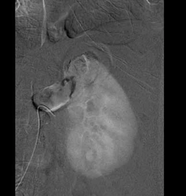 Diagnostická DSA před embolizací
Fig. 1. Diagnostic DSA before embolisation
