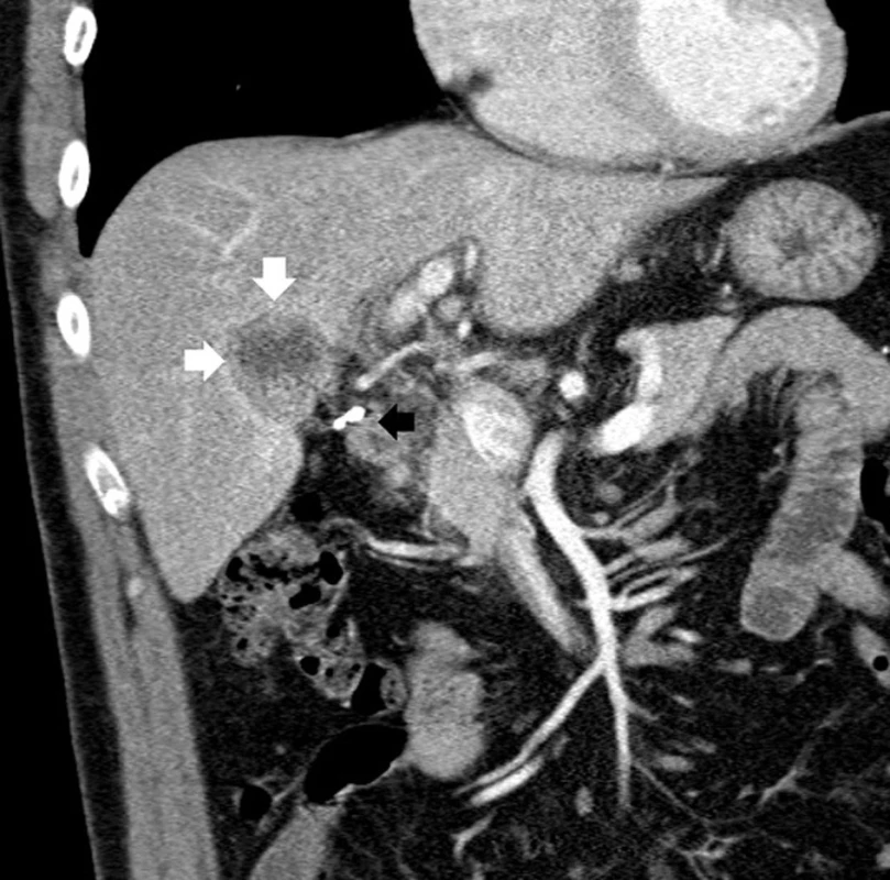 CT obraz intraparenchymatózně uloženého zdvojeného žlučníku (koronární řez) (Bílé šipky ukazují tumorózní útvar v hilu žlučníku, černá šipka svorky po předchozí laparoskopické cholecystektomii.)
Fig. 2: CT image of intraparenchymal double gallbladder (coronal section) (The white arrows are pointing at a tumorous lesion of the gallbladder hilum, the black arrow pointing at clips from previous laparoscopic holecystectomy.) 