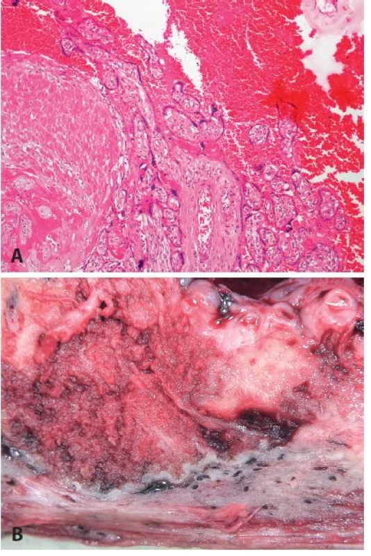 <b>Placenta accreta</b>. Hysterektomie těsně po porodu pro akrétní placentu, pacientka 40 let, stav po těžké endometritidě v minulosti. <b>A</b>: naprosté chybění deciduální tkáně, přímý kontakt choriových klků s myometriem (HE, zvětš. 100x). <b>B</b>: makrofoto.
