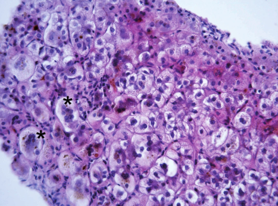 Obraz neonatální hepatitidy u 5měsíčního kojence s progresivní formou BSEP onemocnění s obrovskobuněčnou transformací hepatocytů (ozn. hvězdičkou)místy se zřetelnou převážně intracelulární cholestázou. V lalůčcích přítomny nespecifické zánětlivé změny v podobě histiocytárních uzlíků a lymfoplazmocelulárního infiltrátu.

Fig. 2. The picture of neonatal hepatitis in a 5-month infant with progressive form of BSEP disease with large cellular transformation of hepatocytes (marked with asterisk), occasionally with distinct mostly intracellular cholestasis. In the lobules are present nonspecific inflammatory changes in the form of histiocytic nodules and lymphoplasmocellular infiltrate.
