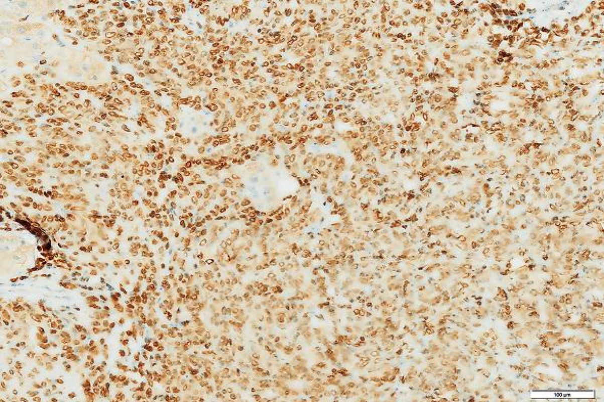 Nádorové buňky exprimovaly marker STAT6. Immunohistologie, měřítko 100 μm.