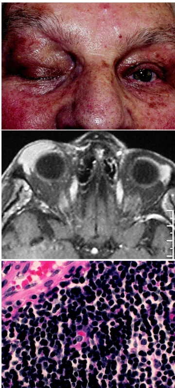 a. Ptóza horního víčka vpravo podmíněná tumorózním vyklenutím
b. MR: tumorózní prominence horního víčka vpravo
c. Histologie: MALT-lymfom, parafin. řez, barvení hematoxylin- eosin, zvětšení 500krát
