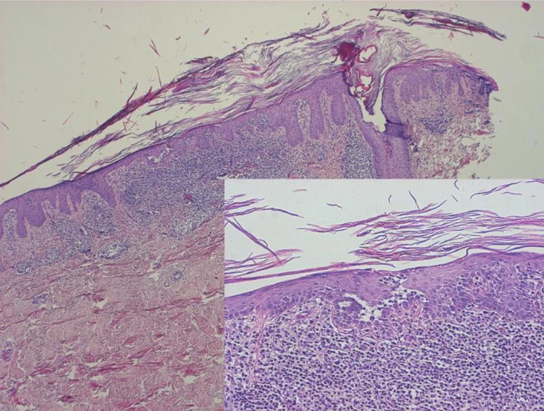 Klasická pityriasis rubra pilaris s fokální akantolýzou folikulárně akcentovaná hyperkeratóza s šachovnicovitě se střídajícími úseky parakeratózy, hypergranulóza