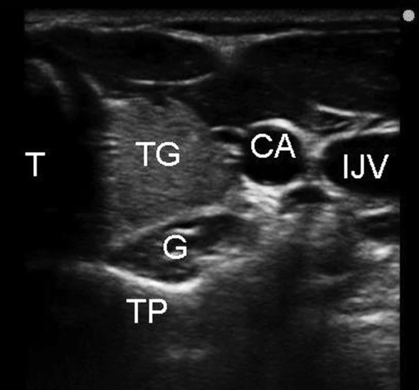 Ultrazvuková anatomie pro blokádu ganglion stellatum
Legenda: T – trachea, TG – štítná žláza, IJV – vena jugularis interna, CA – arteria carotis communis, TP – příčný výběžek C6, G – oblast krčního sympatického ganglia