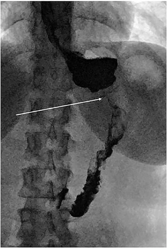 Stenóza tubulizovaného žaludku    Fig. 2: Gastric stenosis after sleeve gastrectomy