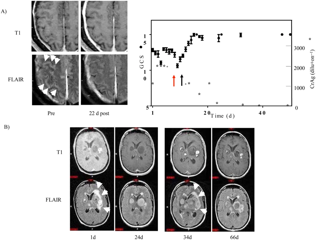 Steroid-responsiveness of s-CNS cryptococcosis in previously healthy patients.