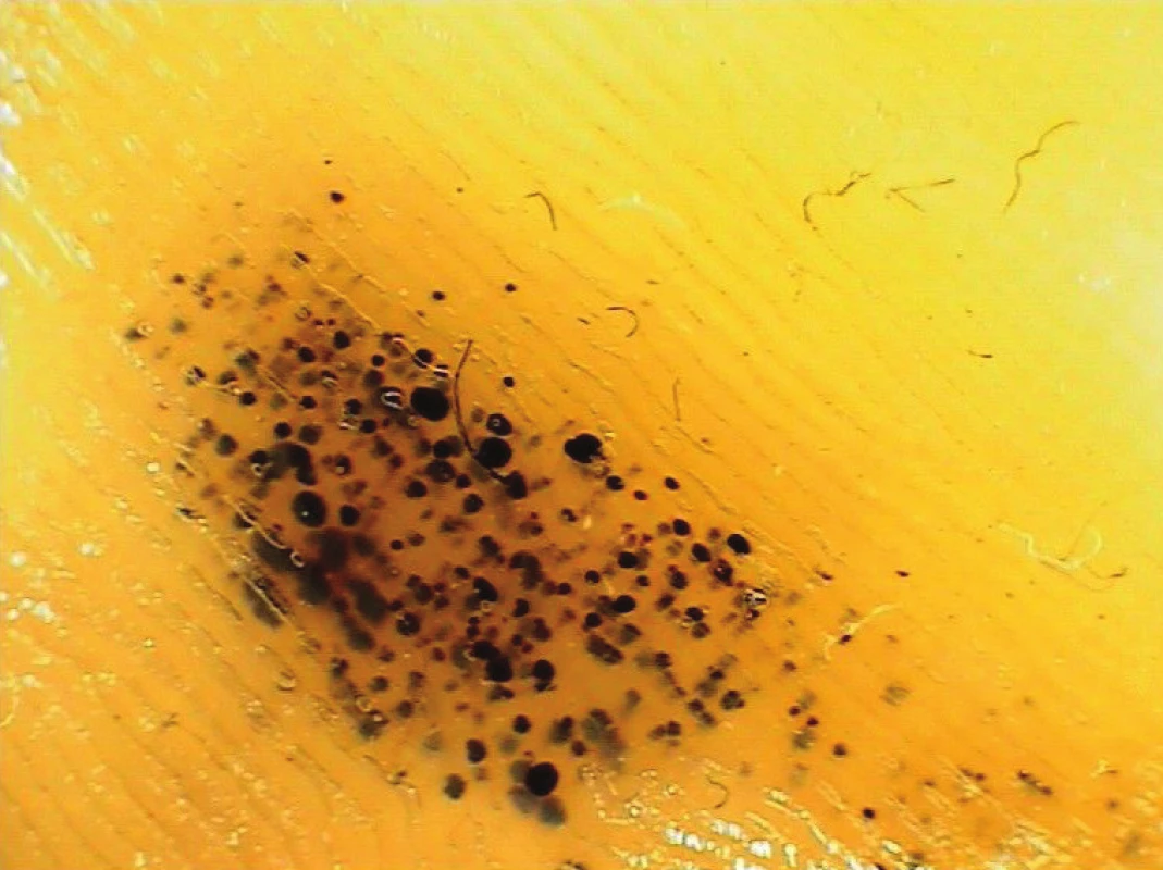 Krvácení do kůže plosky („black heel“)
