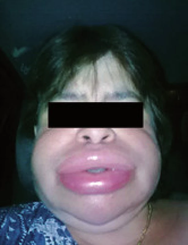Typický obraz angioedému na tvári (pacientka z ambulancie V. internej kliniky, publikované so súhlasom pacientky).
Fig. 3. Clinical picture of angioedema on the face (5. Dpt of Internal Medicine, with agreement of the patient).