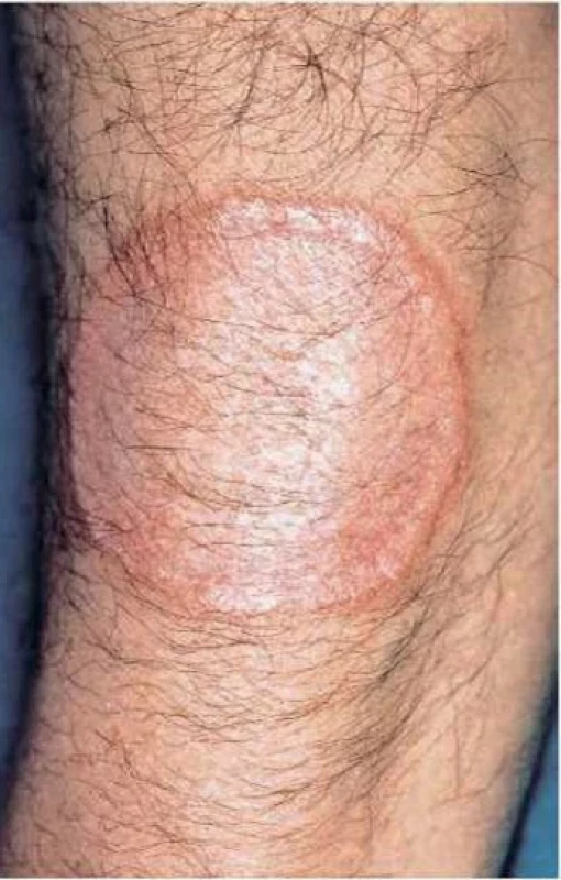 Necrobiosis lipoidica (převzato z 6)