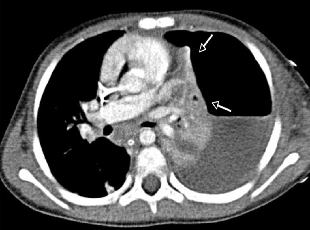 CT vyšetření hrudníku téže pacientky ze dne 30. 11. 2009. – Kompletní kolaps levého plicního křídla směrem k hilu (šipky), ventrálně pneumotorax, dorzálně ostrá hranice kolekce pleurální tekutiny, jejíž denzitometrie odpovídá empyému.<br>
Fig. 2. CT examination of thorax from November 30, 2009 as observed in the same patient. – A complete collapse of the left lung wing in the direction of hilus (arrows), pneumothorax in ventral direction and a sharp border of collected pleural fluid dorsally, with densitometry character corresponding to empyema.