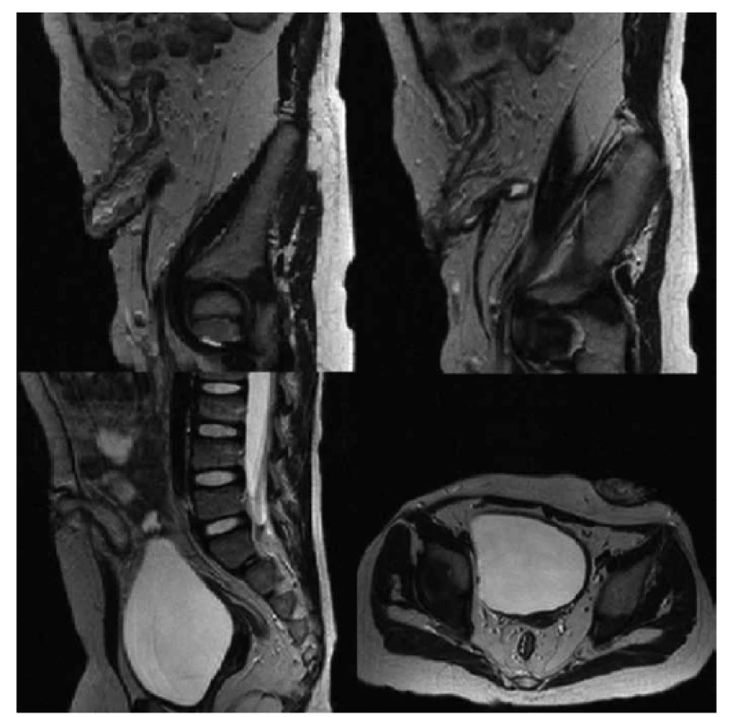 MR vyšetrenie brucha u pacientky s fistulujúcou formou Crohnovej choroby.
Fig. 1. Abdominal MRI scans in patient with fistulating Crohn‘s disease.