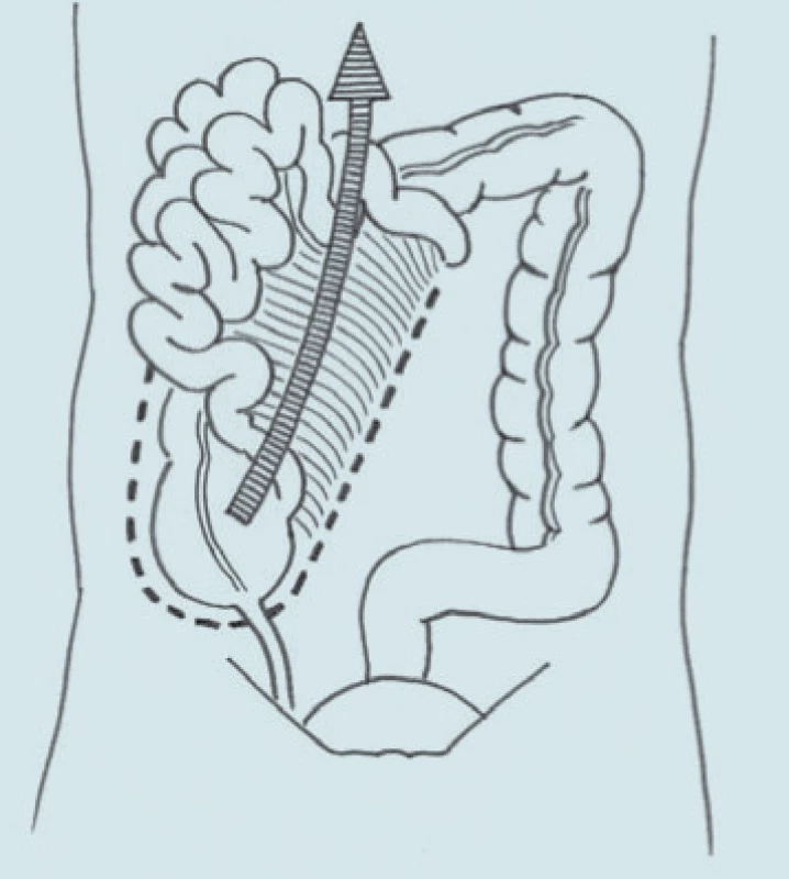 Odklopení colon a kliček střevních.