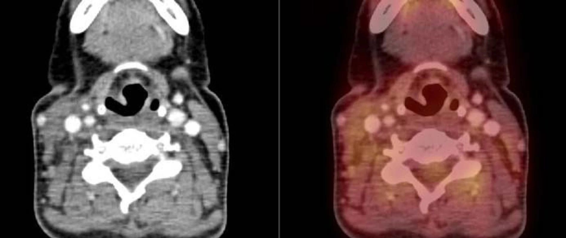 PET/CT v únoru roku 2012 (4 měsíce po totální tyroidektomii, 6 měsíců po ukončení systémové protinádorové terapie). Obrázek vztahující se ke kazuistice č. 2. V měkkých tkáních již bez průkazu patologického vychytávání radioaktivní glukózy.