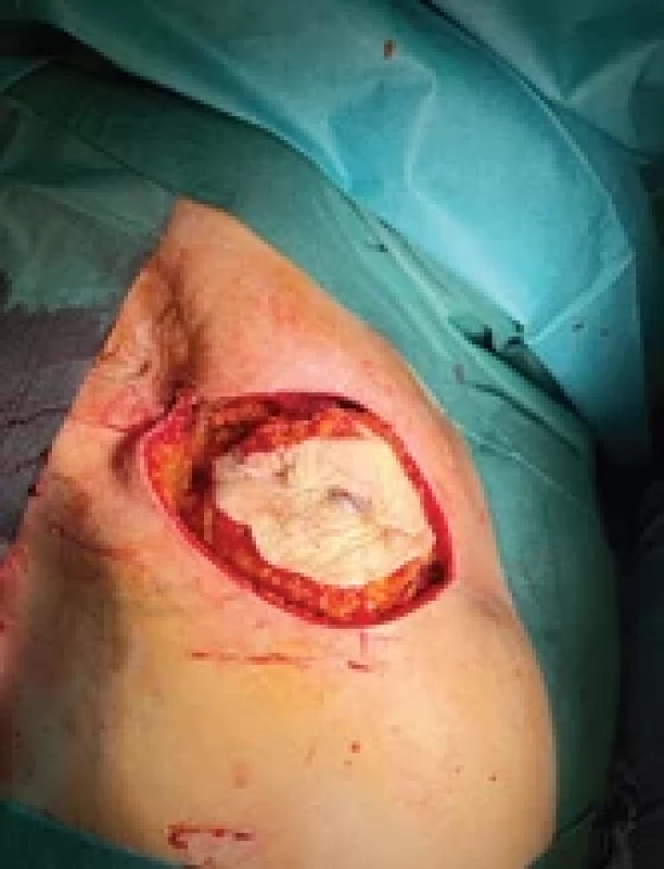 Řešení defektu transpozicí fasciokutánním lalokem. Fig. 3. Reconstruction of the defect using a fasciocutaneous transposition fl ap.