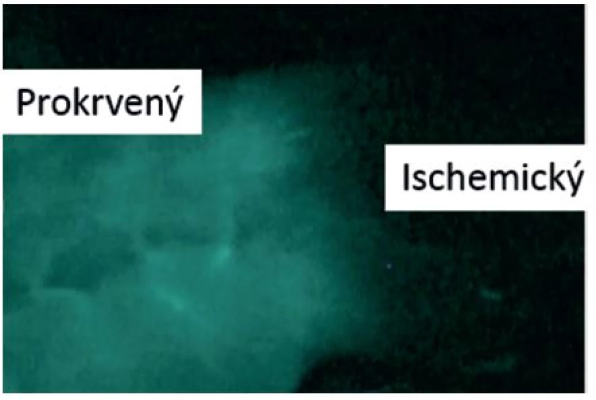 NIR fluorescentní angiografie
Fig. 1: NIR fluorescent angiography