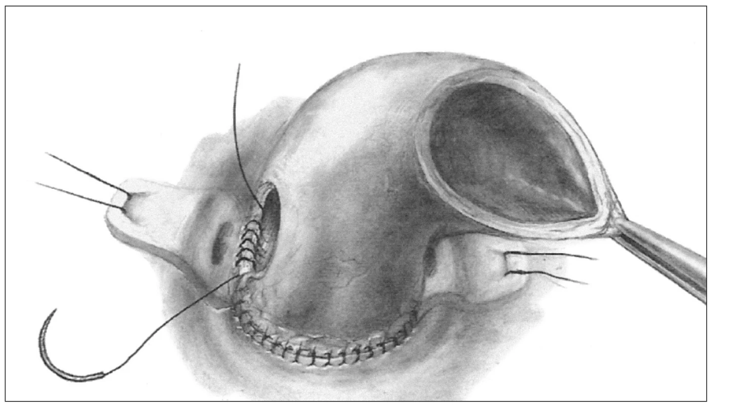 Technika implantace celého kořene, tzv. „full root“.
