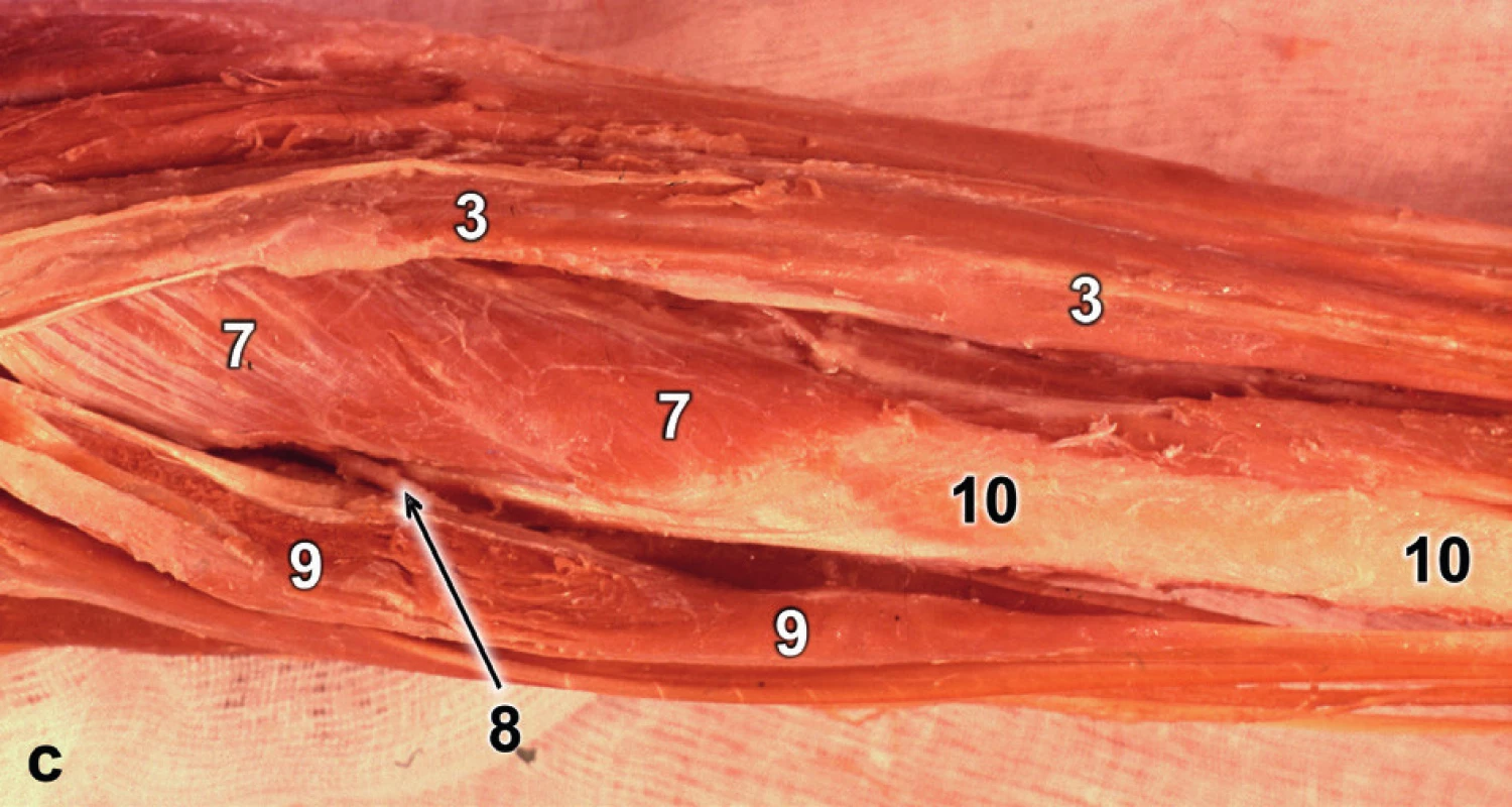 Thompsonův přístup: a – identifikace intervalu mezi m. extensor carpi radialis brevis a m. extensor digitorum; b – preparace v hloubce; c – anatomický preparát: 1 – m. brachioradialis, 2 – m. extensor carpi radialis longus, 3 – m. extensor carpi radialis brevis, 4 – m. abductor pollicis longus, 
5 – m. extensor pollicis brevis, 6 – m. anconeus, 7 – m. supinator, 8 – r. profundus n. radialis, 9 – m. extensor digitorum, 10 – radius. <i>(Reprinted from Bartoníček J. Operační přístupy u zlomenin hlavičky a diafýzy rádia. Acta Chir Orthop Traumatol Čech 1988;55:497−516.)</i>
Fig. 7: Thompson approach: a – identification of interval between extensor carpi radialis brevis and extensor digitorum; b – deep dissection; c – anatomical specimen: 1 – brachioradialis, 2 – extensor carpi radialis longus, 3 – extensor carpi radialis brevis, 4 – abductor pollicis longus, 5 – extensor pollicis brevis, 6 – anconeus, 7 – supinator, 8 – deep branch of radial nerve, 9 – extensor digitorum, 10 – radius. <i>(Reprinted from Bartoníček J. [Surgical approaches in fractures of the head and shaft of radius]. Acta Chir Orthop Traumatol Čech 1988;55:497−516.)</i>