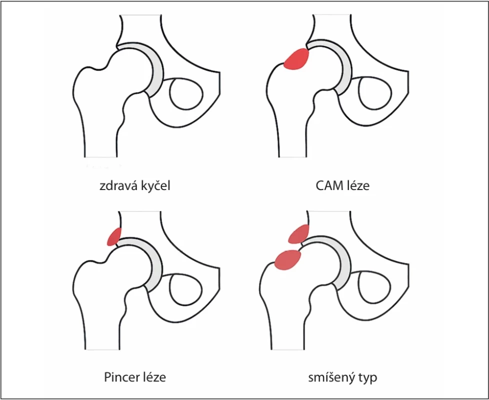 Schematické znázornění typů femoroacetabulárního impingementu  (vytvořeno pomocí AI). Fig. 1. Schematic representation of the types of femoroacetabular impingements  (created using AI).