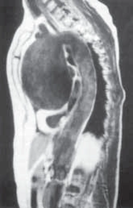 Aneuryzma ascendentní aorty zobrazené pomocí NMR.