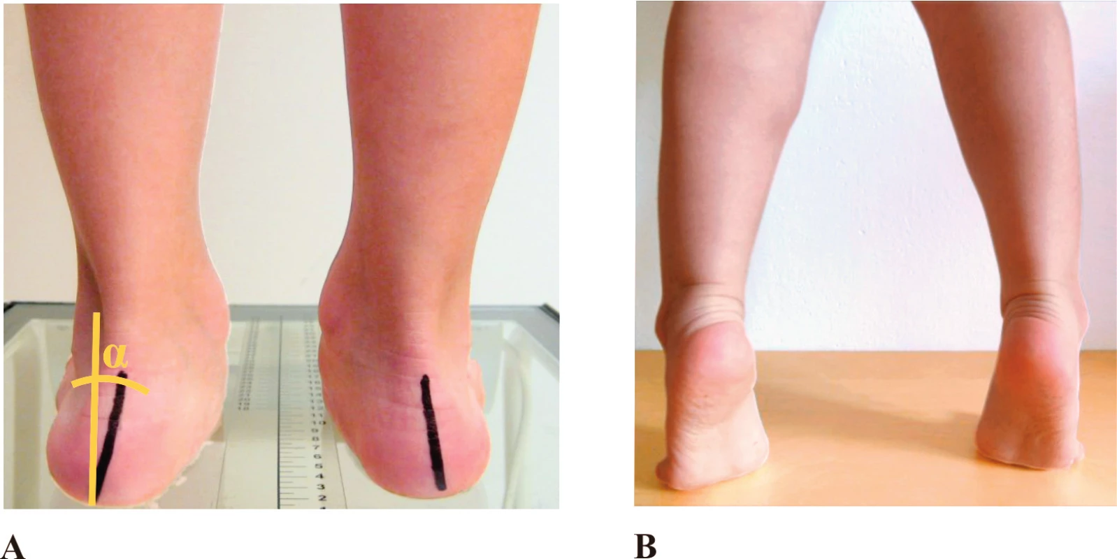 A: určení statické valgozity paty (α); B: dynamický Jack test.
Fig. 1. A: evaluation of static heel valgus (α); B: Dynamic Jack’s test.