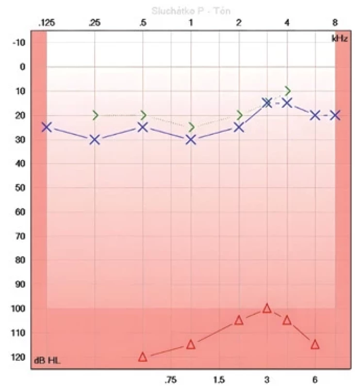 Audiogram progrese poruchy do praktické hluchoty vpravo.  Fig. 4. Audiogram showing progression of the disorder to practical deafness in the right ear.