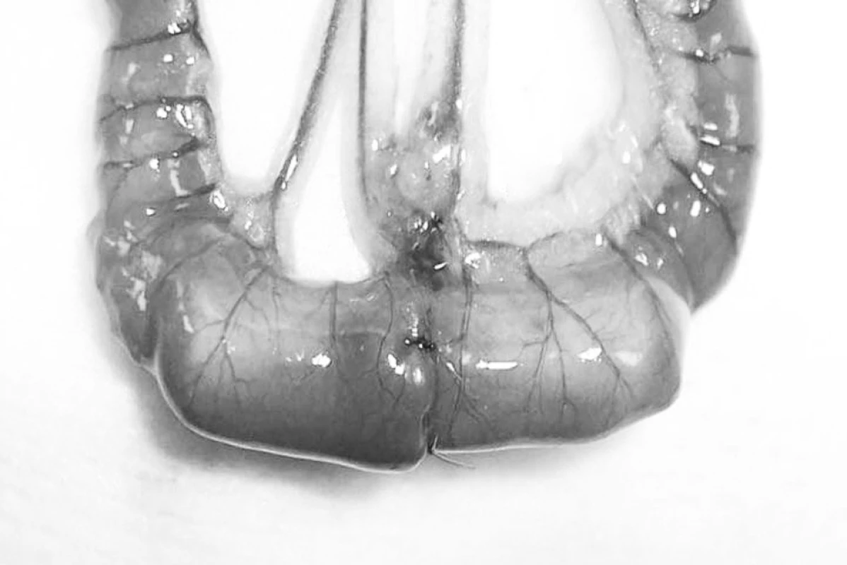 Při aproximační anastomóze je kontinuita a integrita střeva zajištěna 5 seromuskulárními stehy
Fig. 1. In approximative anastomosis, the continuity and integrity of bowel is achieved with 5 seromuscular stitches