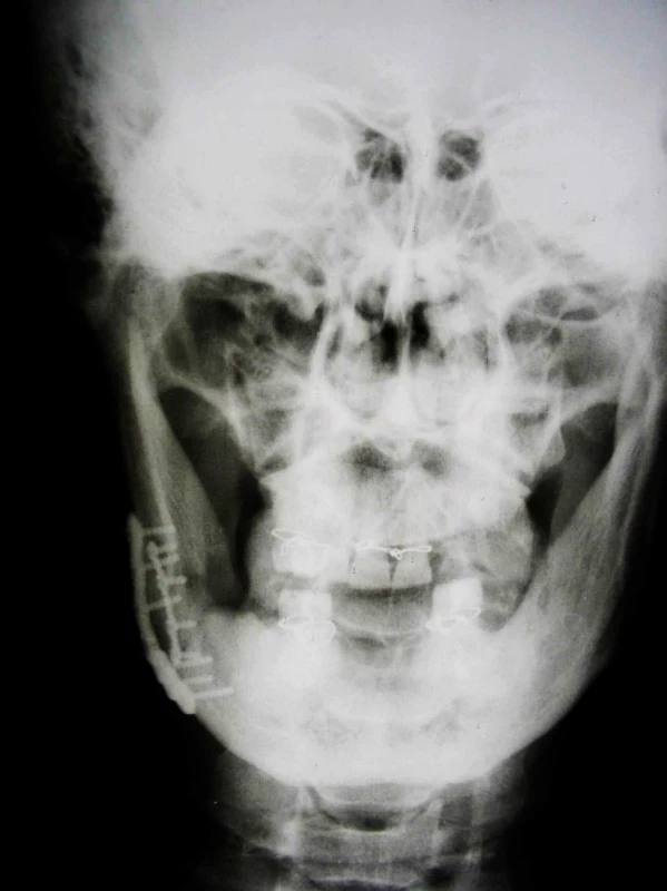 Zlomenina čelistního úhlu, ošetřená rigidní osteosyntézou