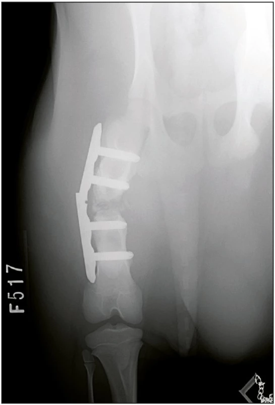 Selhání osteosyntézy - zlomená LCP dlaha při zatěžování končetiny