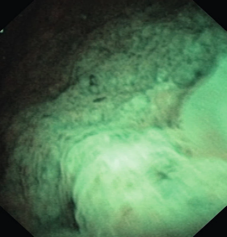 Cystoskopie před operací (NBI)
Fib. 3 Cystoscopy prior TUR (NBI)