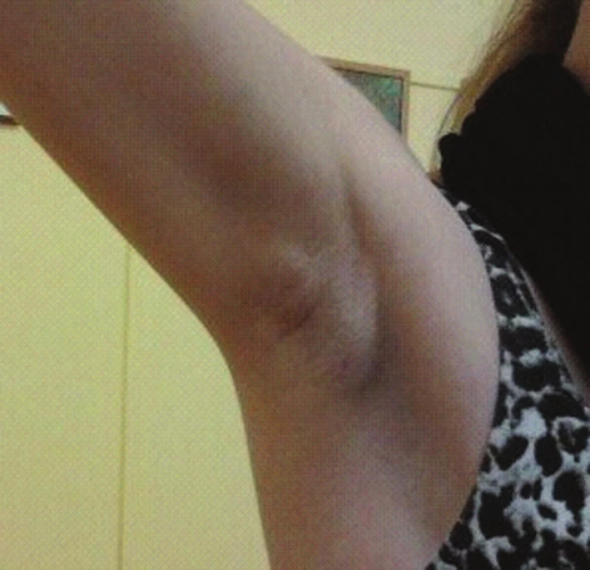 Aberantný prsník pravého podpazušia
Fig. 2: Aberrant breast of the right armpit