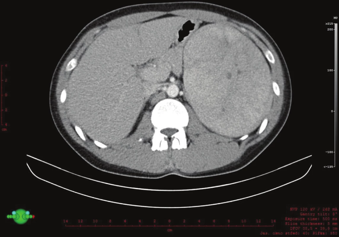 Záchyt expanze v levém podžebří na CT, transverzální řez
Fig. 2: Expansion in the left hypochondrium on a transverse CT scan