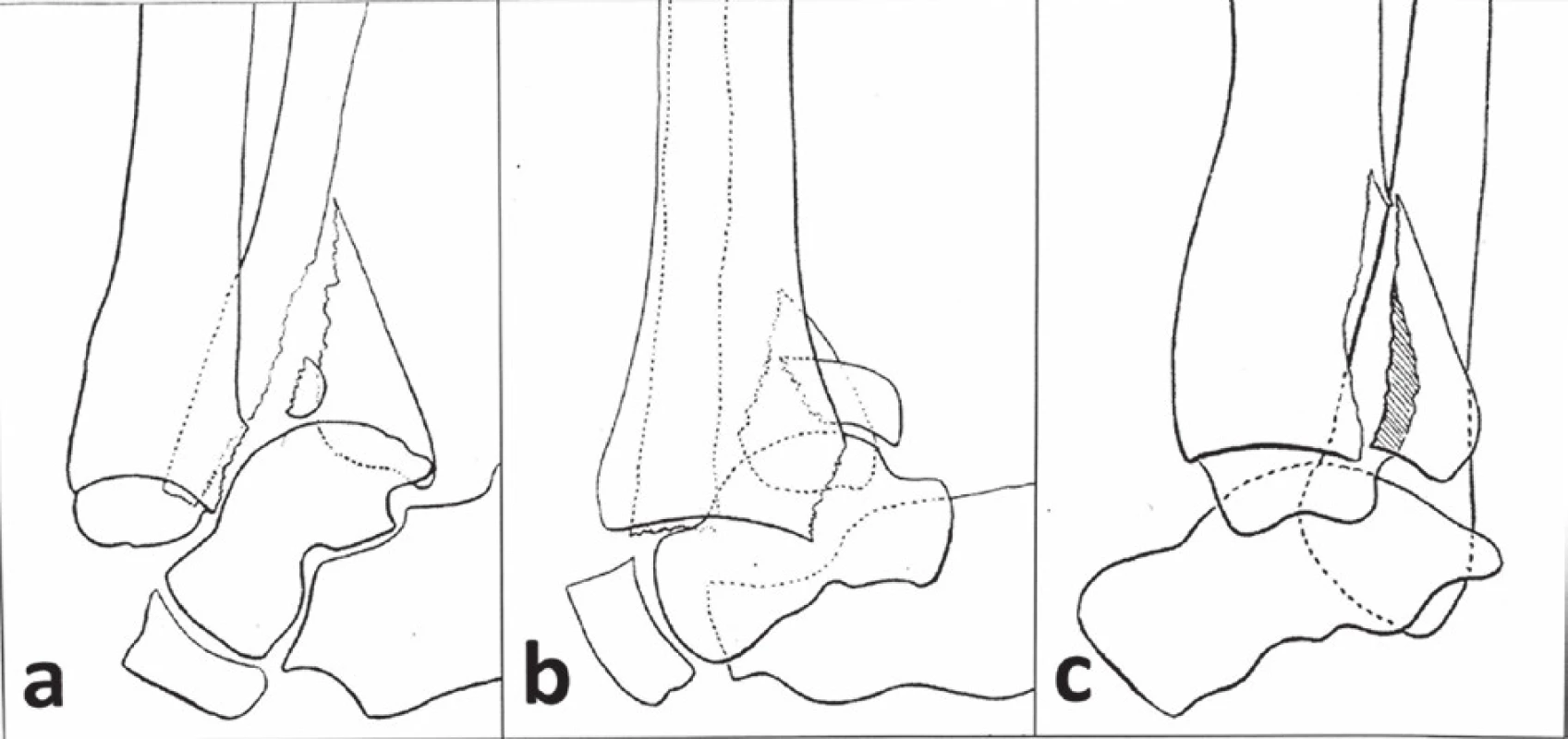 Ashhurstova klasifikace z r. 1922
a – malý fragment, b – střední fragment, c – velký fragment. Adaptováno z [24].
Fig. 2: Ashhurst classification published in 1922
a – small fragment, b – medium fragment, c – large fragment. Adapted from [24].