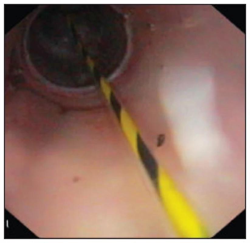Transrektální vstup provedený pomocí jehlového nože s následnou dilatací balonem (pohled do dutiny břišní přes dilatační balon)
Fig. 1. Transrectal access created by needle knife followed by balloon dilatation (endoscopic view to the peritoneal cavity through the insufflated balloon)