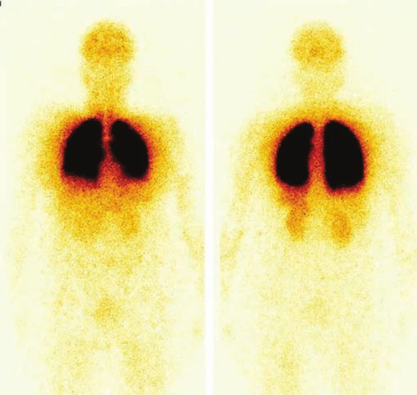 Celotělová scintigrafie s <sup>99m</sup>Tc-MAA. Je patrná extrapulmonární akumulace radiofarmaka v mozku, ledvinách a ve slezině, což svědčí pro přítomnost P-L zkratu. Přední a zadní projekce.