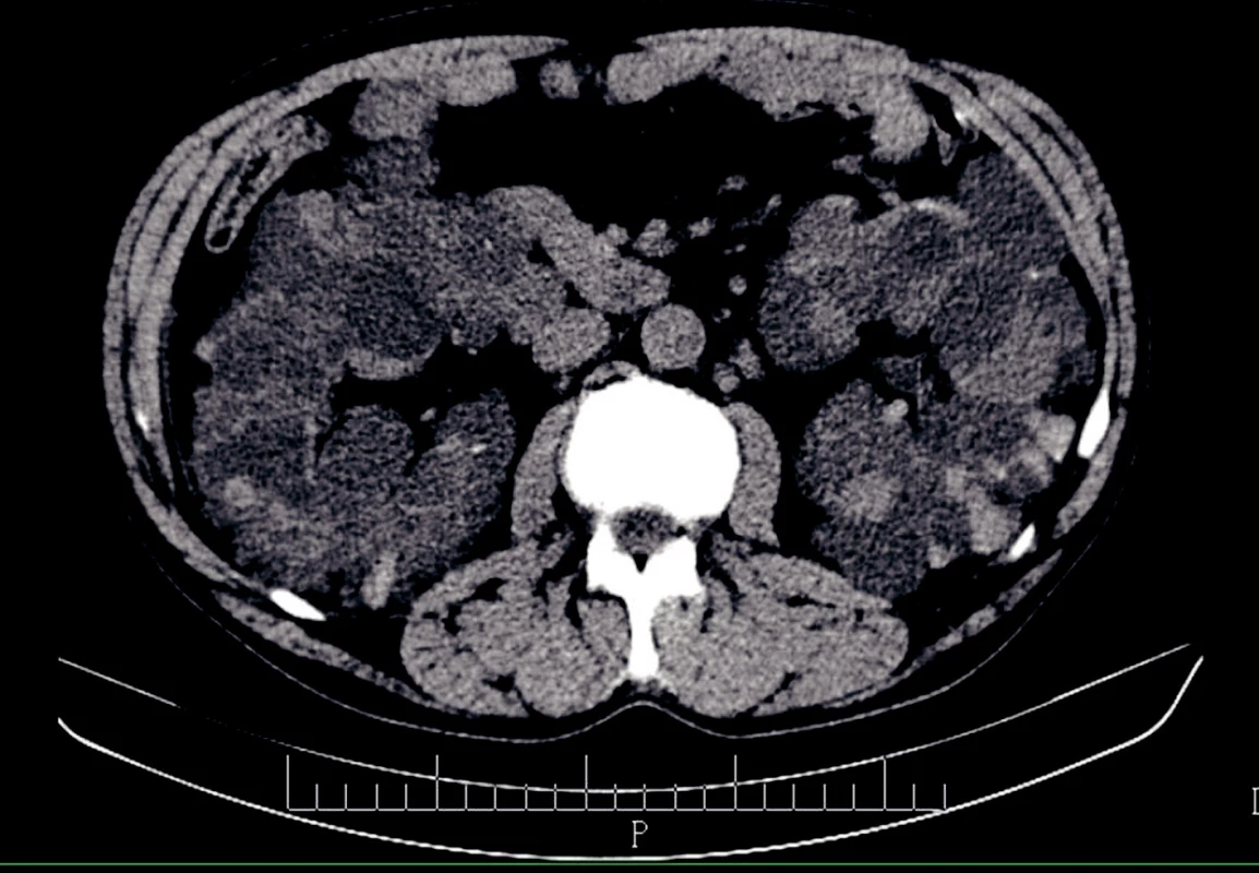 Probíhající hemodialýza. Radiocefalická arteriovenózní fistule na levé horní končetině.
