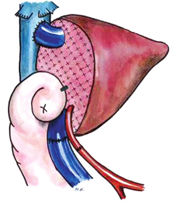 Transplantace redukovaného štěpu II+ III
Fig. 2. Transplantation of the reduced grafts II+ III
