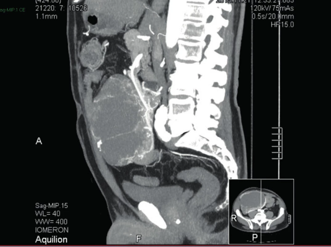 CT břicha a malé pánve MIP (maximum intensity projection ) v sagitální rovině
Fig. 5: CT scan of abdomen and pelvis MIP (maximum intensity projection ) sagittal view