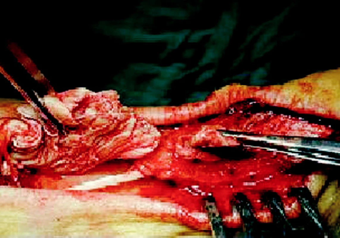 Ruptura Achillovy šlachy
Pic. 2. Achilles tendon rupture
