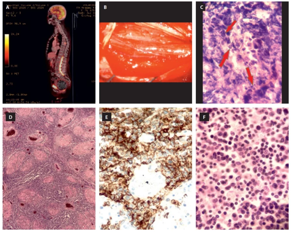 Vyšetření pomocí 18F FDG-PET/CT odhalilo zvýšenou akumulaci radiofarmaka v celé délce páteřního kanálu v lumbální oblasti spolu s ložiskem v obratli Th7 (A). Peroperační snímek edematózních kořenů po durotomii a laminektomii L3 ilustruje difuzní charakter patologie (B). Bioptické vyšetření vzorku odebraného mezi kořeny cauda equina prokazuje přítomnost lymfoidních elementů suspektní z lymfomové infi ltrace (C) (HE, zvětšení 10×). Histologické a imunohistochemické vyšetření nekropsie prokazuje rozsáhlou infi ltraci celého rozsahu cauda equiny (D) (HE, 4×). Pozitivita barvení CD 20 (E) (CD 2%, 10×) a záplava lymfocytů (F) (HE, 40×) svědčící pro diagnózu primárního difúzního velkobuněčného B lymfomu GC-like typu v oblasti cauda equina. HE – hematoxilin-eosin