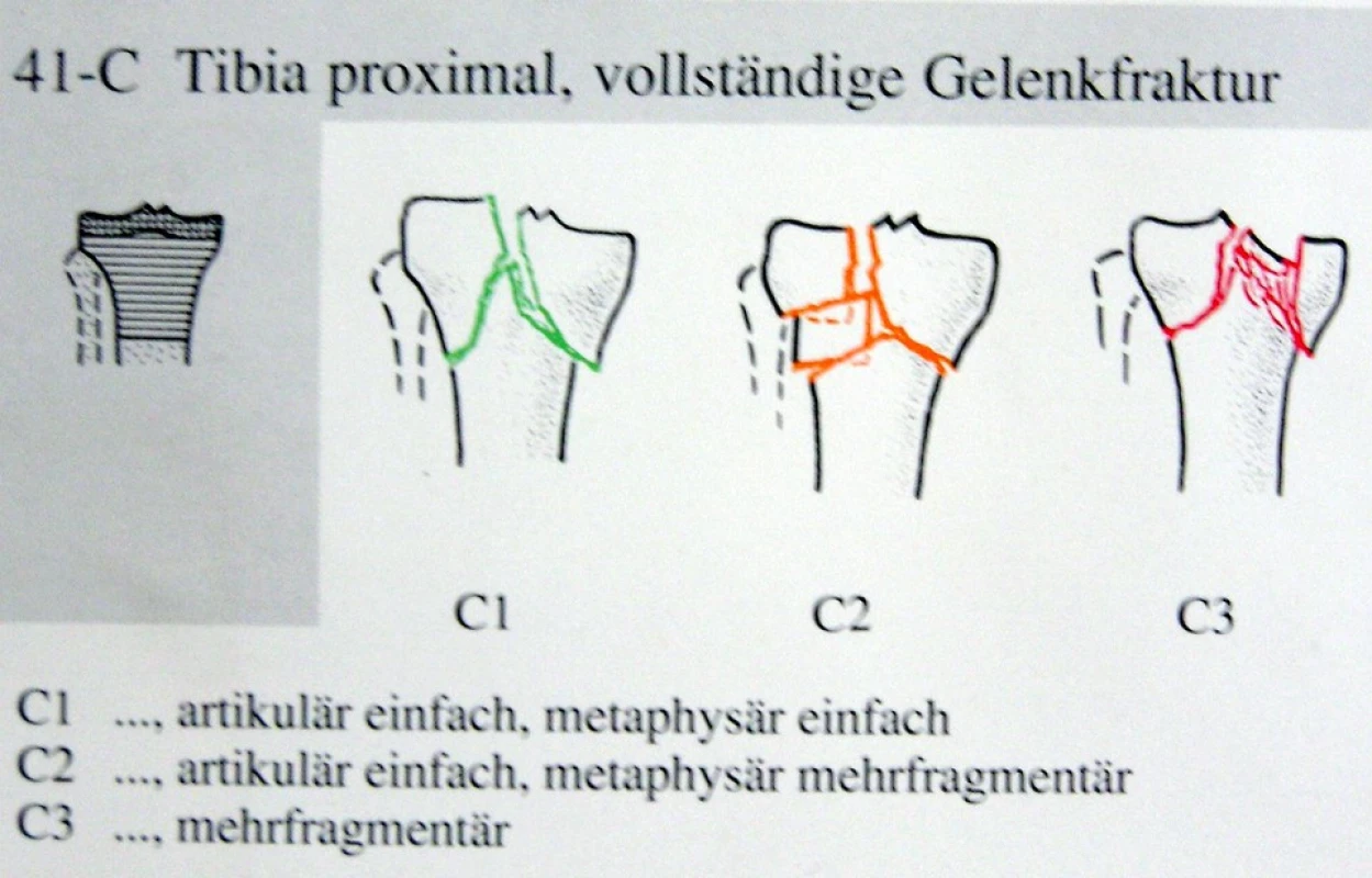 Klasifikace zlomenin dle AO
