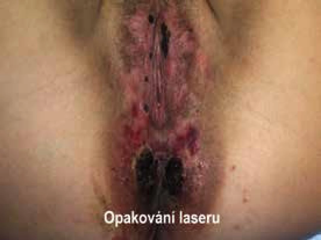 Stav po 2měsíční léčbě a dalším ošetření laserem